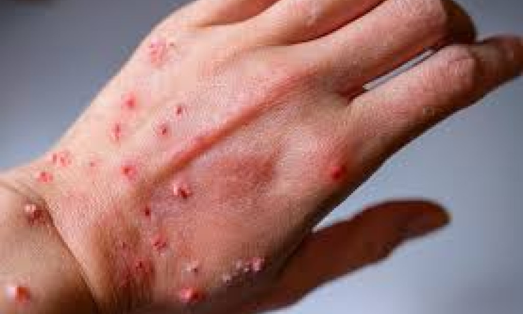 Understanding Mpox: Origins, Causes, Prevention, and Recent Rise